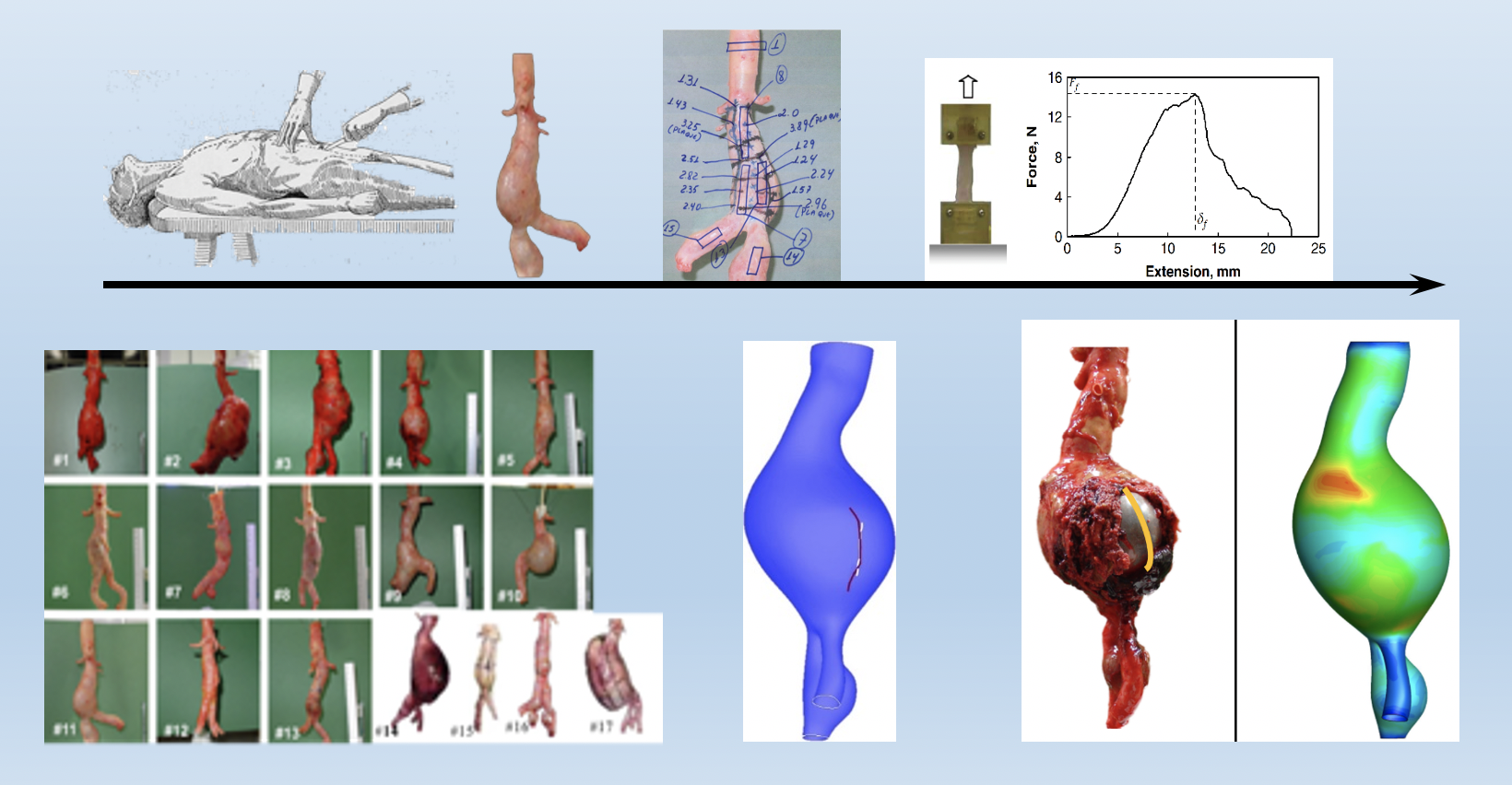 Abdominal Aortic Aneurysm